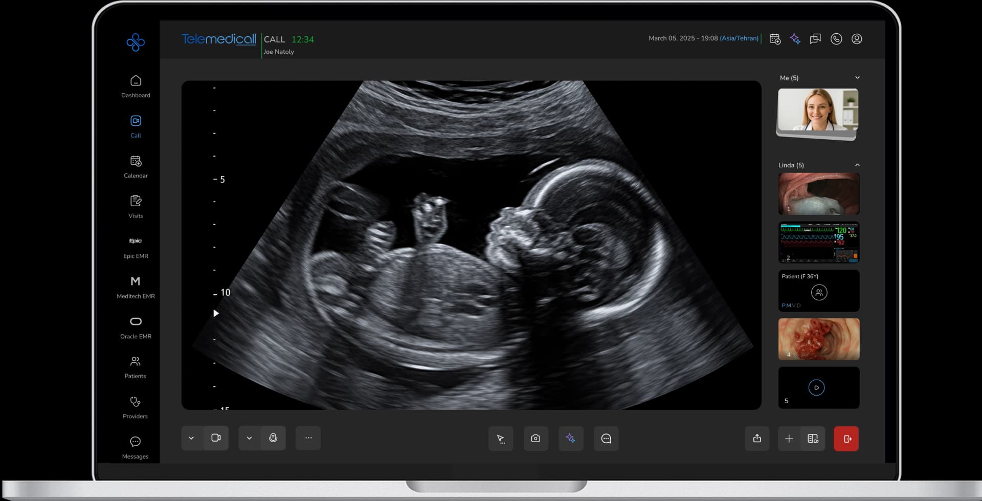 Ultrasound sonography via Telemedicall